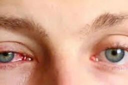 Nguy cơ đục giác mạc nghiêm trọng khi sử dụng chế phẩm chứa brimonidin tartrat